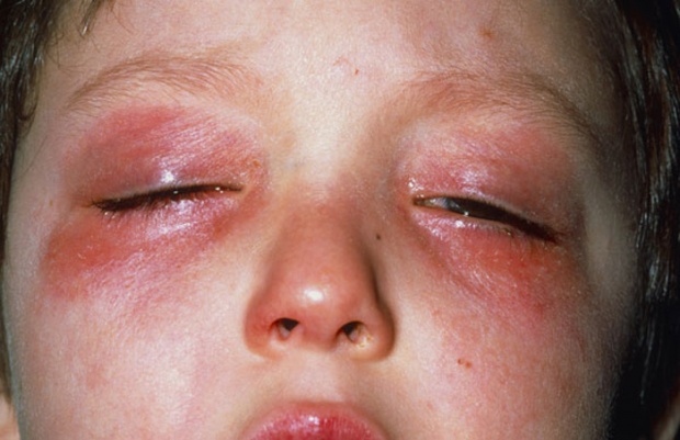 8 สาเหตุของโรคภูมิแพ้ขึ้นตาเด็ก วิธีสังเกตอาการ