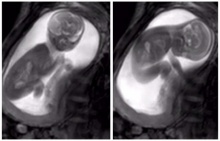 ดูลูกในครรรภ์แบบใหม่ด้วยเครื่อง MRI เห็นแม้กระทั่งทารกกลืนน้ำคร่ำ