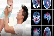 วิธีสังเกตอาการลูกเส้นเลือดสมองแตกในเด็ก อันตรายถึงชีวิต!