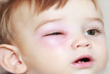 ภูมิแพ้ขึ้นตาในเด็ก ต้องรักษาที่ต้นเหตุ